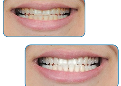 Efectos Secundarios del Blanqueamiento dental