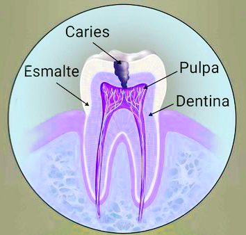 Caries dental  San Juan del Rio