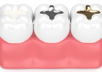 ¿Que es una obturación dental?