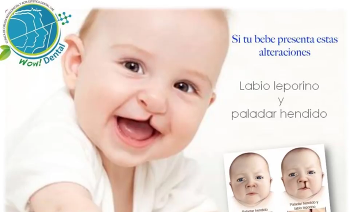 Labio Y Paladar Hendido Clinica Wow Dental San Juan Del Rio 0663