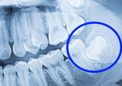 Radiografias Dentales