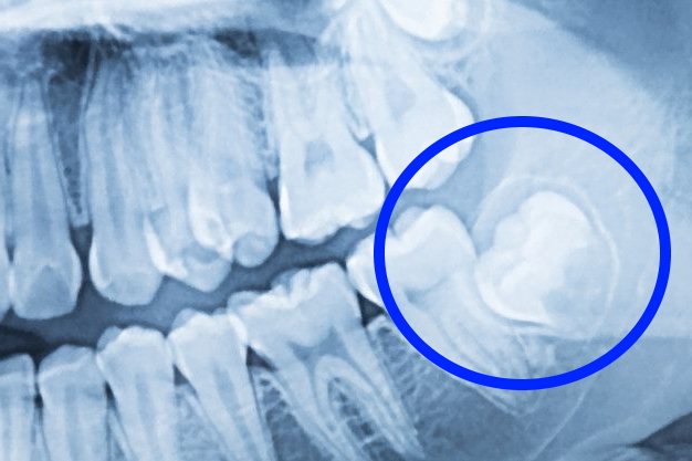 Radiografias Dentales